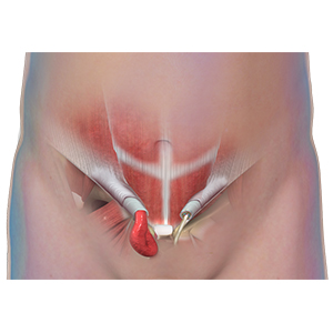 Picture of Inguinal Hernia