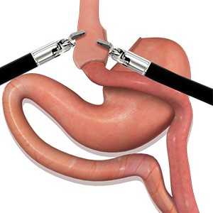 Picture of Laparoscopic Gastric Bypass