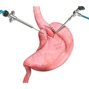 Picture of Laparoscopic Reflux Surgery