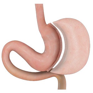 Picture of Laparoscopic Sleeve Gastrectomy