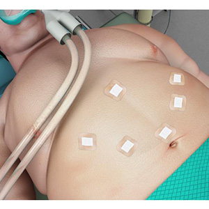 Picture of Laparoscopic Weight Loss Surgery