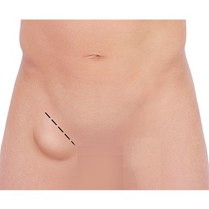 Picture of Open Hernia Surgery