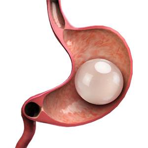 Picture of Orbera Managed Weight Loss System