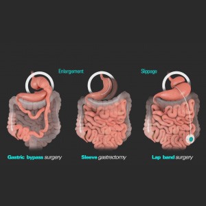Picture of Revision or Failed Weight Loss Surgery