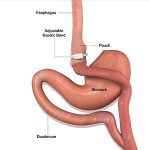 Picture of Revision Weight Loss Surgery