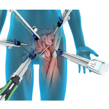 Picture of Robotic Hernia Surgery