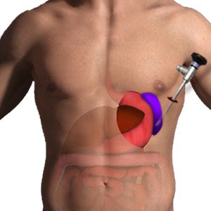 Picture of Splenectomy