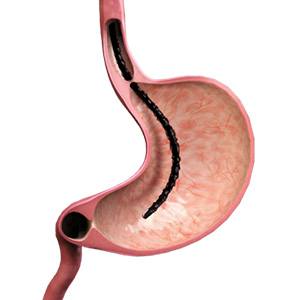 Picture of Upper GI Endoscopy