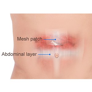 Picture of Ventral Hernia Repair
