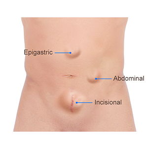 Picture of Ventral Hernia