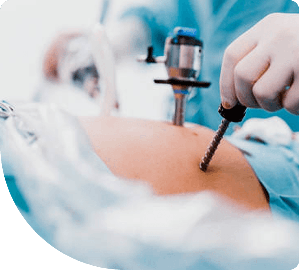 Laparoscopic Weight Loss Surgery