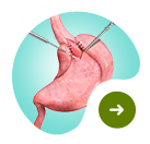 Reflux and Foregut Surgery Small Picture