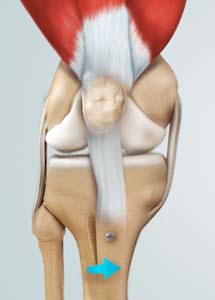 Knee Osteotomy pic