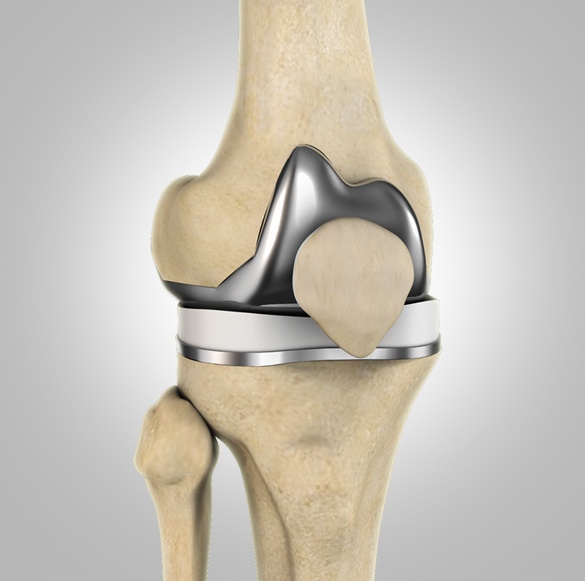 Total Knee Replacement