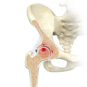Acetabular Subchondral Cysts Images