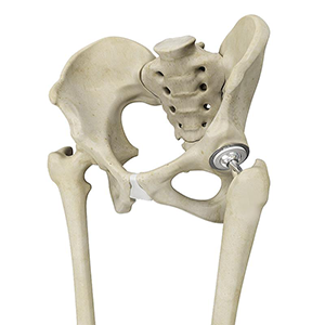 Complex Primary Hip Replacement - Dr. Ryan Werntz