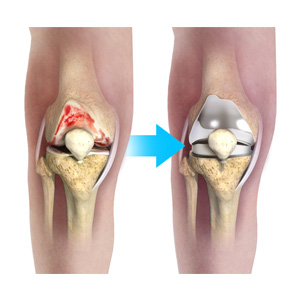 Complex Total Knee Replacement Images