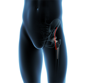 Direct Anterior Approach Hip Replacement Surgery Images