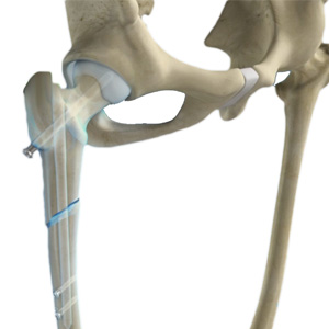 Femoral Nails Images