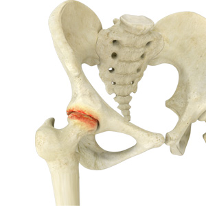 Hip Arthritis - Dr. Ryan Werntz