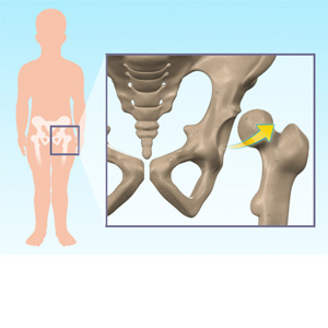 Hip Dysplasia Images