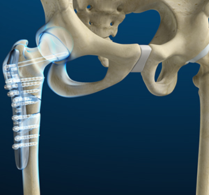 Hip Fracture Surgery - Dr. Ryan Werntz