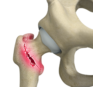 Hip Fracture Images