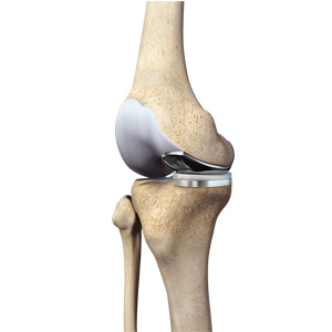 Partial Medial Knee Replacement Images