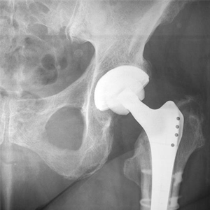 Periprosthetic Fractures - Dr. Ryan Werntz