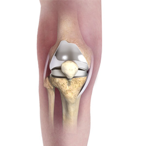 Primary Knee Replacement Images
