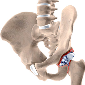 Revision Hip Surgery Images