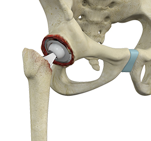 Revision Hip Replacement Images