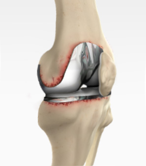 Revision Knee Replacement Images