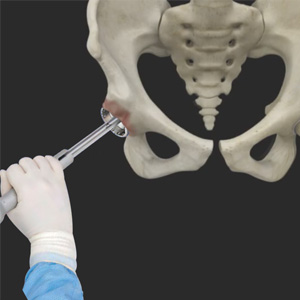 Robotic-Assisted Hip Replacement Images