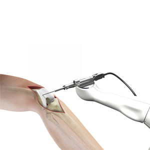 Robotic Assisted Partial Knee Surgery Images