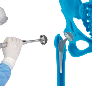Robotic Total Hip Replacement - Dr. Ryan Werntz