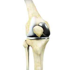 Robotic Unicondylar Knee Replacement Images