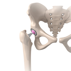 Same Day Hip Replacement - Dr. Ryan Werntz