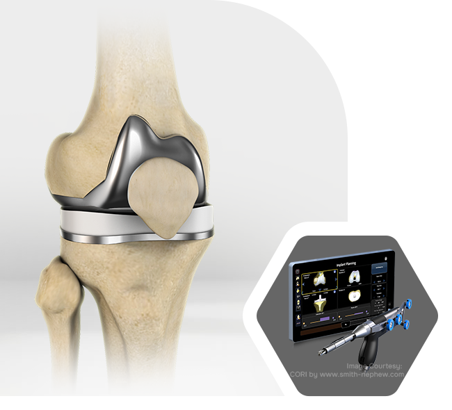 Revision Knee Surgery