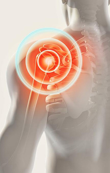 Understanding Shoulder Arthritis