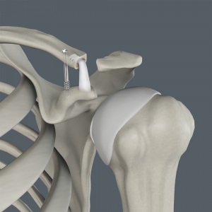 Acromioclavicular (AC) Joint Reconstruction pic