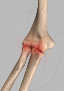 Elbow Arthritis  pic