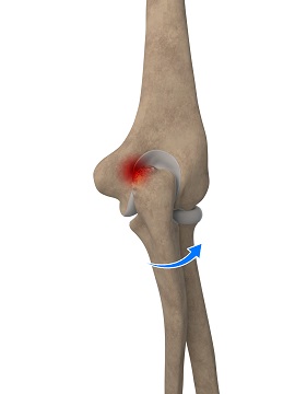 Elbow Impingement pic