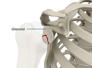 Glenoid Fractures pic