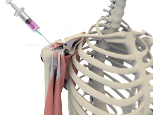 Orthobiologic Treatments for Rotator Cuff Tears pic