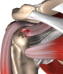Arthroscopic Rotator Cuff Repair pic