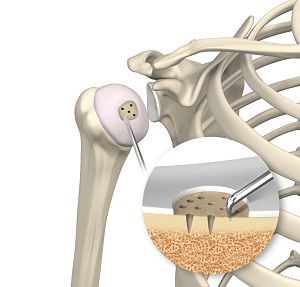 Shoulder Preservation Surgery pic