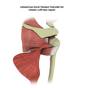 Shoulder Tendon Transfer pic