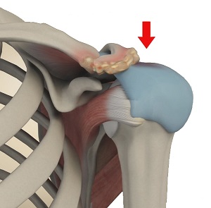 Subacromial Impingement Syndrome pic