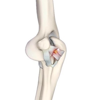 Ulnar Collateral Ligament (UCL) Injury pic